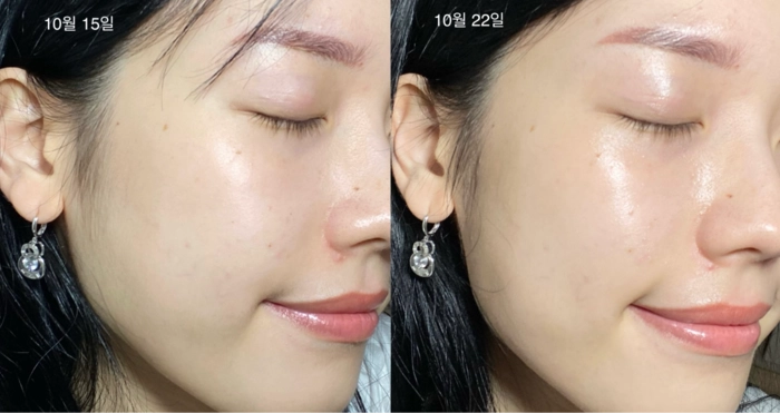 2시간 뒤 가격 상승💸 흉터성모공 개선 실험 성공! 피부과 모공슈링커 비밀특가