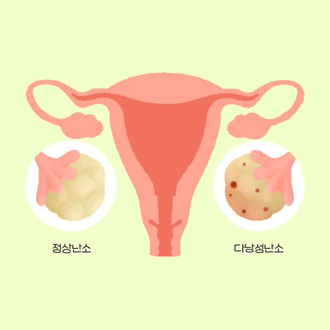 정상 난소와 다낭성 난소를 비교하며 가운데에 자궁이 놓여있음. 다낭성 난소 증후군의 증상을 설명하는 그림