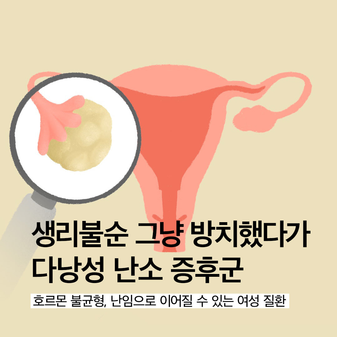 아무리 운동해도 살이 안빠질 때.. “다낭성 난소 증후군”